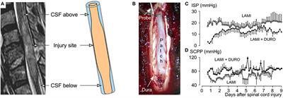 Acute Traumatic Spinal Cord Injury in Humans, Dogs, and Other Mammals: The Under-appreciated Role of the Dura